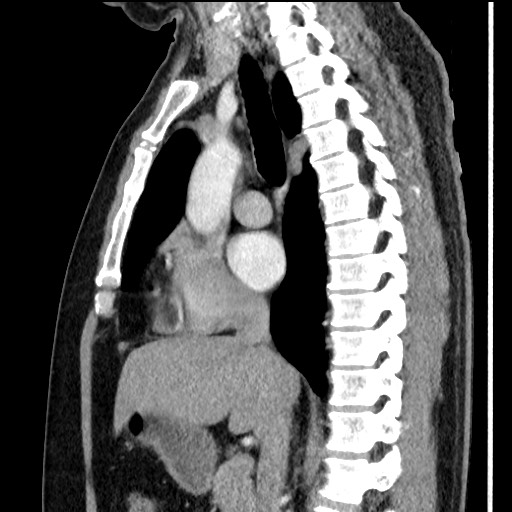 Bronchial carcinoid tumor (Radiopaedia 67377-76764 E 33).jpg