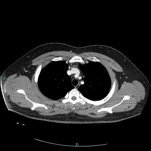 Bronchial carcinoid tumor (Radiopaedia 78272-90875 A 28).jpg
