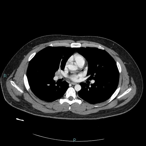 Bronchial carcinoid tumor (Radiopaedia 78272-90875 A 51).jpg