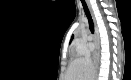 Bronchial mucoepidermoid carcinoma (Radiopaedia 57023-63895 Sagittal 106).jpg