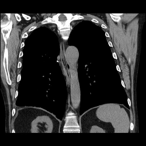 Bronchial stenosis - lung transplant (Radiopaedia 73133-83848 Coronal non-contrast 43).jpg