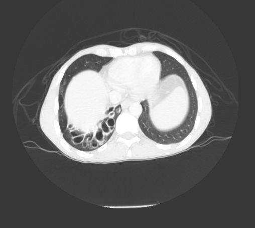 File:Bronchiectasis in Crohn disease (Radiopaedia 60311-67977 Axial lung window 19).jpg