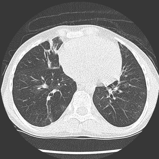 Bronchiolotis obliterans (Radiopaedia 73769-84575 Axial lung window 31).jpg
