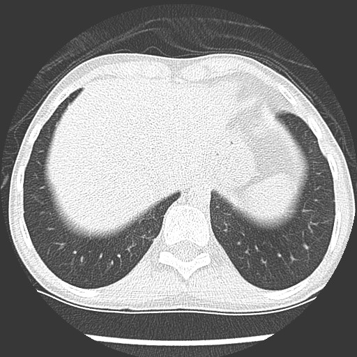 Bronchiolotis obliterans (Radiopaedia 73769-84575 Axial lung window 41).jpg