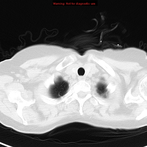 File:Bronchoalveolar carcinoma (BAC) (Radiopaedia 13436-13392 Axial lung window 3).jpg
