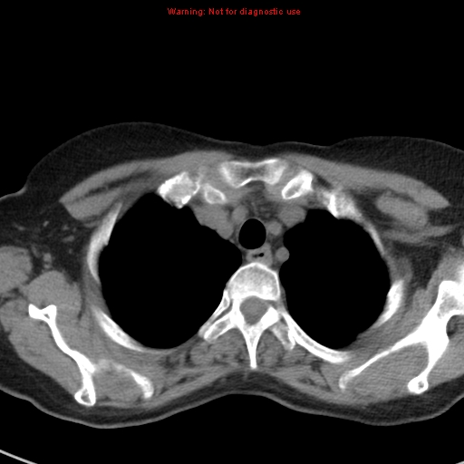 File:Bronchoalveolar carcinoma (BAC) (Radiopaedia 13436-13392 Axial non-contrast 8).jpg