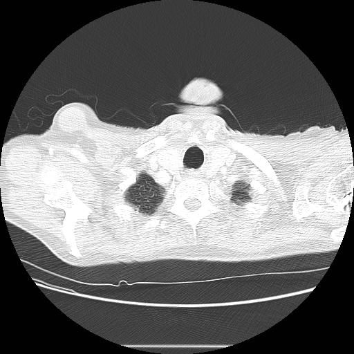 Bronchocele (Radiopaedia 17097-16795 Axial lung window 9).jpg