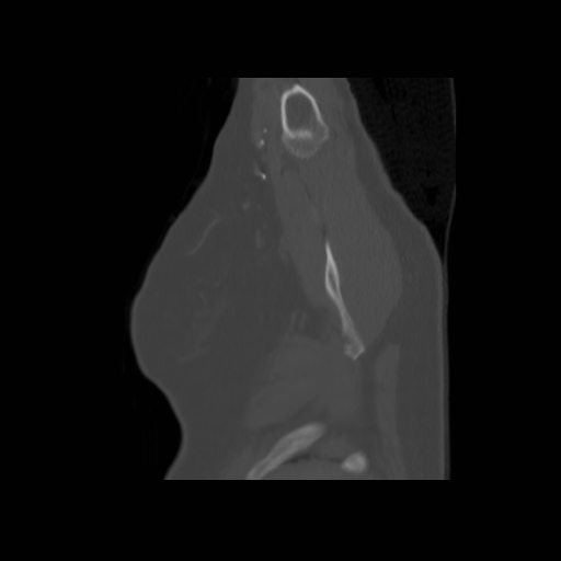 Bronchogenic carcinoma (Radiopaedia 73497-84262 Sagittal bone window 19).jpg