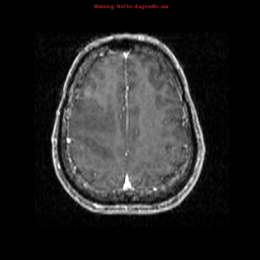 File:Bronchogenic carcinoma brain metastasis (Radiopaedia 9286-9969 Axial T1 C+ 19).jpg