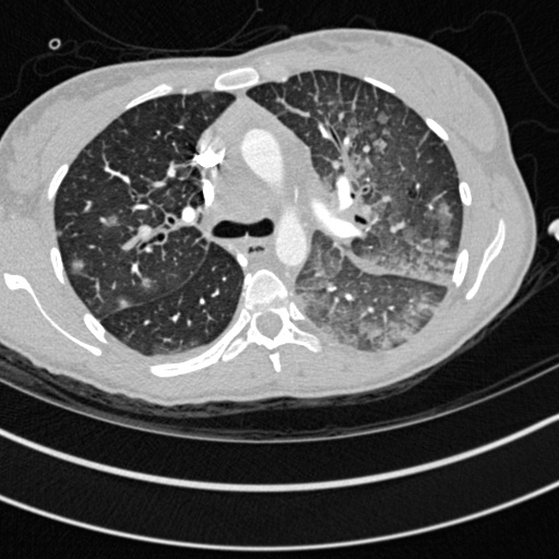 Bronchogenic cyst (Radiopaedia 77801-90071 Axial lung window 20).jpg