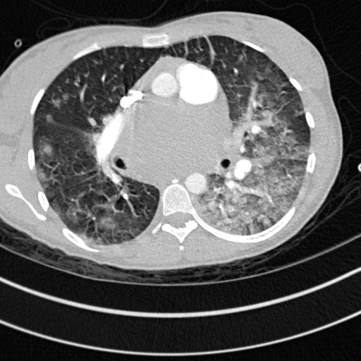 Bronchogenic cyst (Radiopaedia 77801-90071 Axial lung window 33).jpg