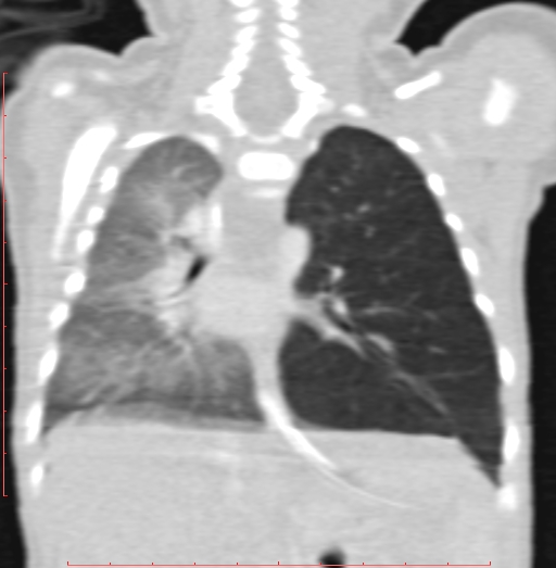 Bronchogenic cyst (Radiopaedia 78599-91409 Coronal lung window 141).jpg