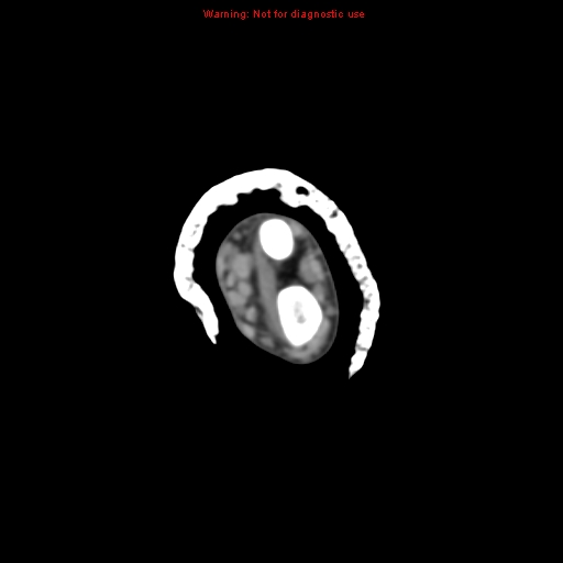 File:Brown tumor (Radiopaedia 12460-12694 Axial non-contrast 26).jpg