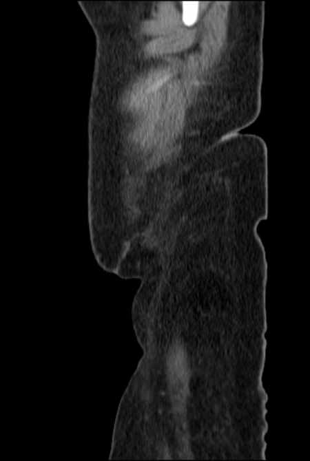 Brown tumors compressing the spinal cord (Radiopaedia 68442-77988 F 3).jpg