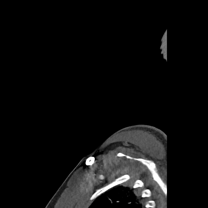 Buccal fat pad arteriovenous malformation (Radiopaedia 70936-81144 C 15).jpg