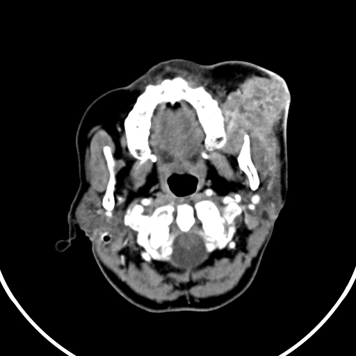 File:Buccal squamous cell carcinoma (Radiopaedia 8520-9346 A 13).jpg