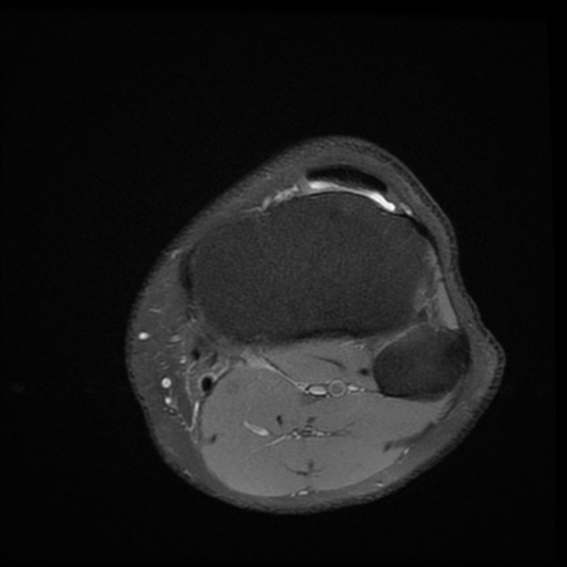 File:Bucket-handle meniscus tear (Radiopaedia 65700-74809 Axial PD fat sat 23).jpg