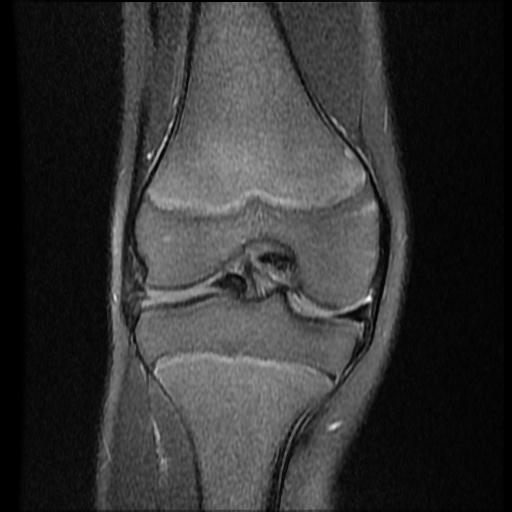 File:Bucket handle tear - lateral meniscus (Radiopaedia 72124-82634 Coronal PD fat sat 9).jpg