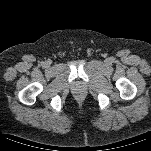 File:Burned-out testicular seminoma - retroperitoneal nodal metastases (Radiopaedia 62872-71245 A 74).jpg