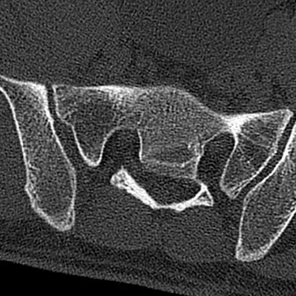 Burst fracture (Radiopaedia 53373-59357 Axial bone window 74).jpg