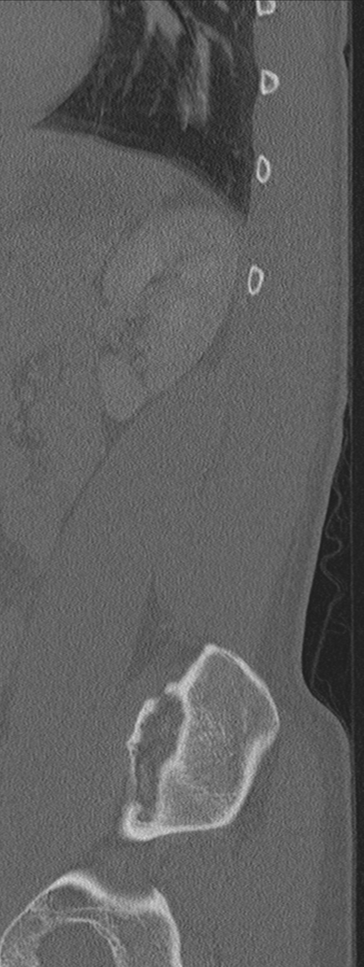 Burst fracture - T12 with conus compression (Radiopaedia 56825-63647 Sagittal bone window 9).png