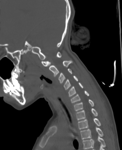 Butterfly vertebra (Radiopaedia 77903-90209 Sagittal bone window 63).jpg
