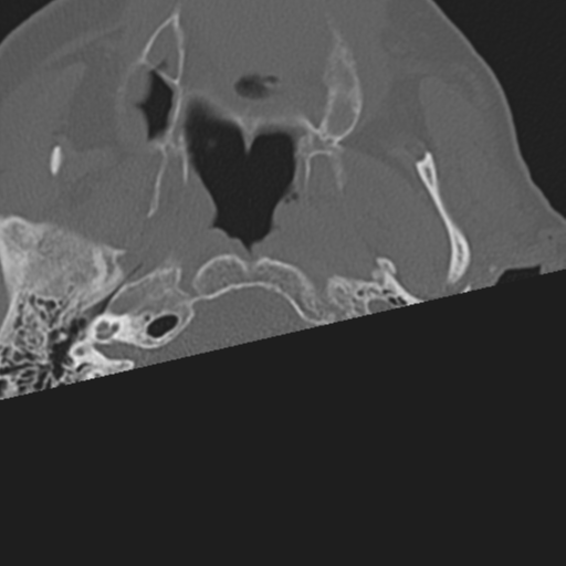 C2 fracture with vertebral artery dissection (Radiopaedia 37378-39199 Axial bone window 2).png