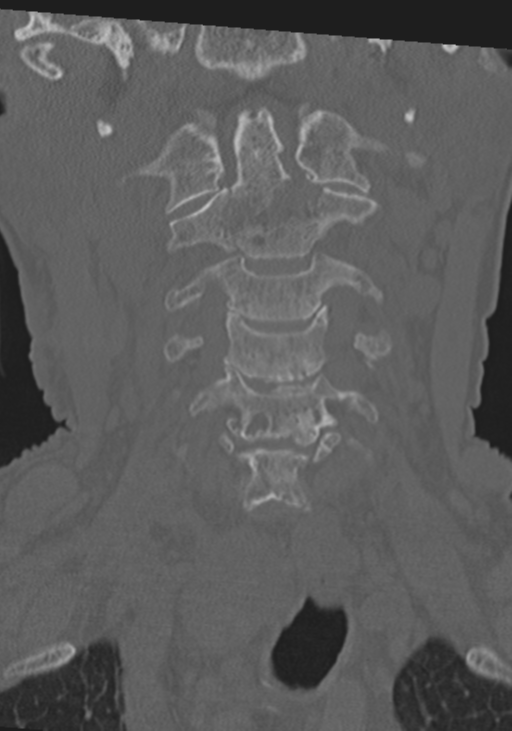 C2 fracture with vertebral artery dissection (Radiopaedia 37378-39199 Coronal bone window 12).png