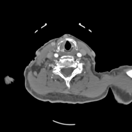 File:C2 fracture with vertebral artery dissection (Radiopaedia 37378-39200 A 106).png