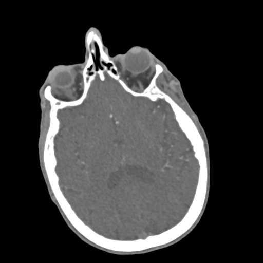 File:C2 fracture with vertebral artery dissection (Radiopaedia 37378-39200 A 251).png
