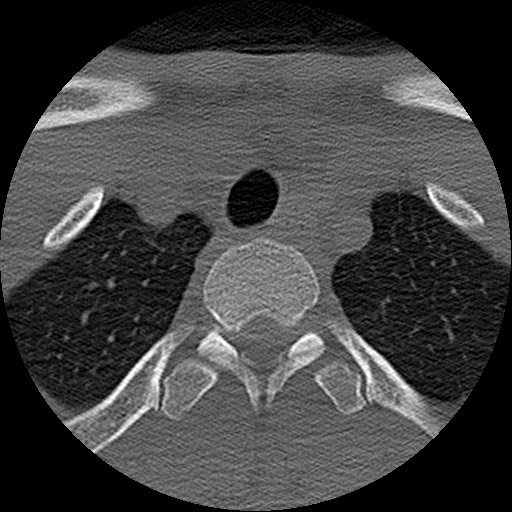 File:C5 facet fracture (Radiopaedia 58374-65499 Axial bone window 95).jpg