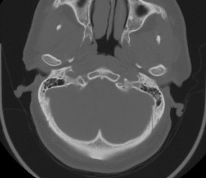 C7 laminar fracture and Klippel-Feil syndrome (Radiopaedia 86710-102850 Axial bone window 16).jpg