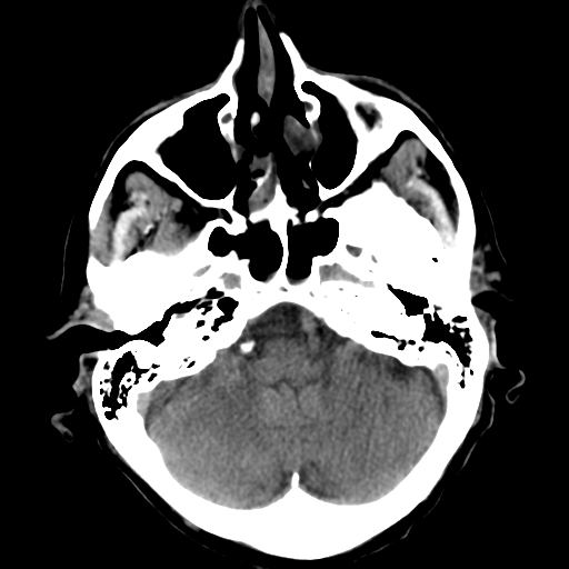File:CNS lymphoma (Radiopaedia 36983-38639 Axial non-contrast 11).png