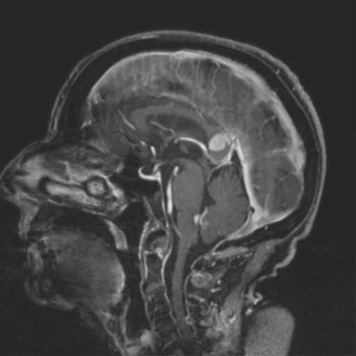 CNS lymphoma with steroid response (Radiopaedia 37980-39921 Coronal T1 C+ 54).png