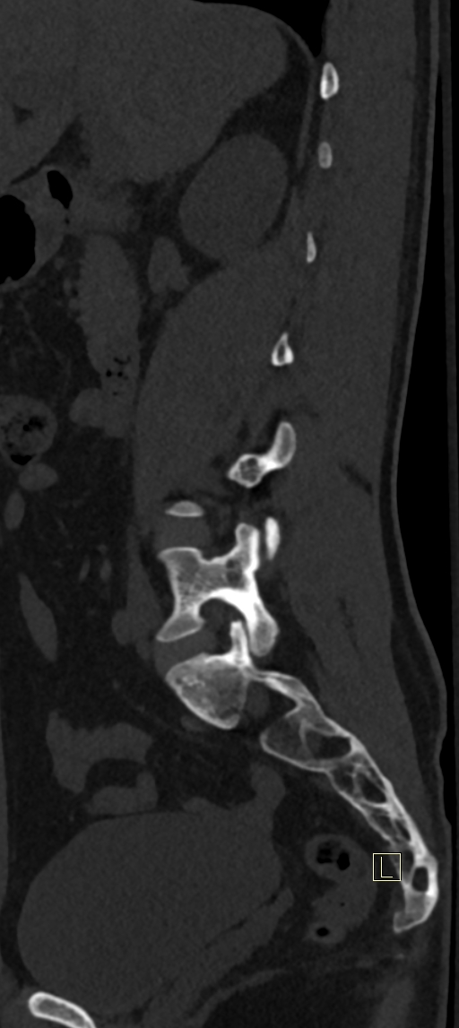 Calcaneal fractures with associated L2 burst fracture (Radiopaedia 71671-82493 Sagittal bone window 58).jpg