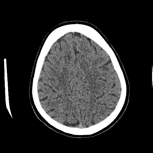 Calcified cerebral hydatid cyst (Radiopaedia 65603-74717 Axial non-contrast 59).jpg