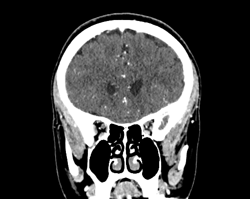 Calcified cerebral hydatid cyst (Radiopaedia 65603-74717 C 19).jpg