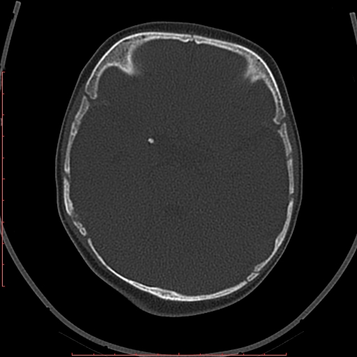 Calcified middle cerebral artery embolism (Radiopaedia 78949-91860 Axial bone window 17).jpg