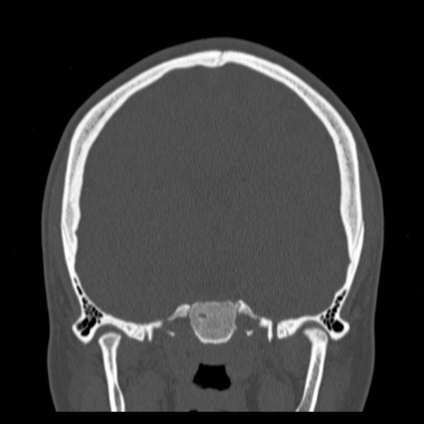 Calvarial osteoma (Radiopaedia 36520-38079 C 46).jpg