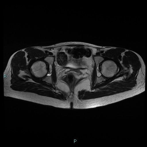 File:Canal of Nuck cyst (Radiopaedia 55074-61448 Axial T2 14).jpg