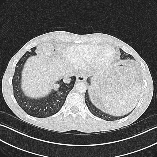 Cannonball metastases - testicular choriocarcinoma (Radiopaedia 84510-99891 Axial lung window 79).jpg