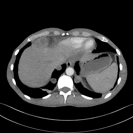 Cannonball metastases - testicular choriocarcinoma (Radiopaedia 84510-99891 B 92).jpg