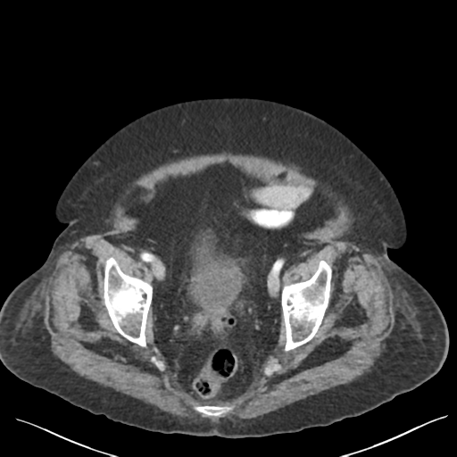 Cannonball metastases from endometrial cancer (Radiopaedia 42003-45031 E 67).png