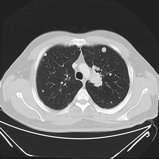 File:Cannonball pulmonary metastases (Radiopaedia 67684-77101 Axial lung window 7).jpg