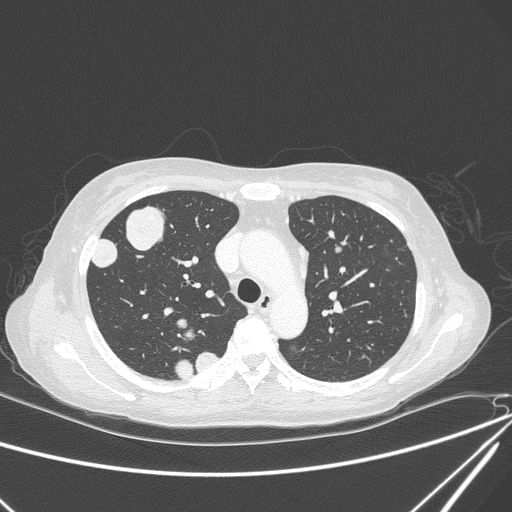 Canonball lung metastasis (Radiopaedia 77634-89837 Axial lung window 58).jpg