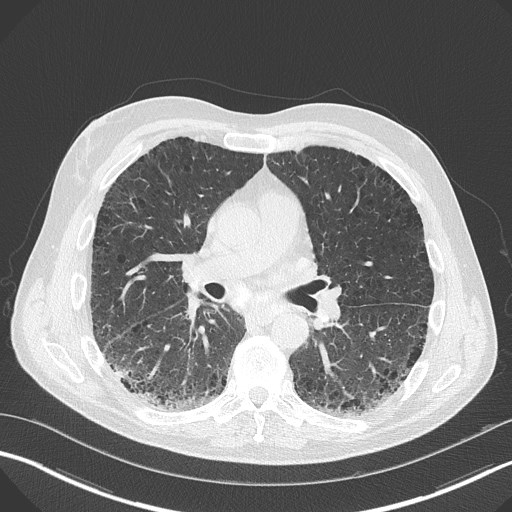 Caplan syndrome (Radiopaedia 56667-63530 Axial lung window 101).jpg