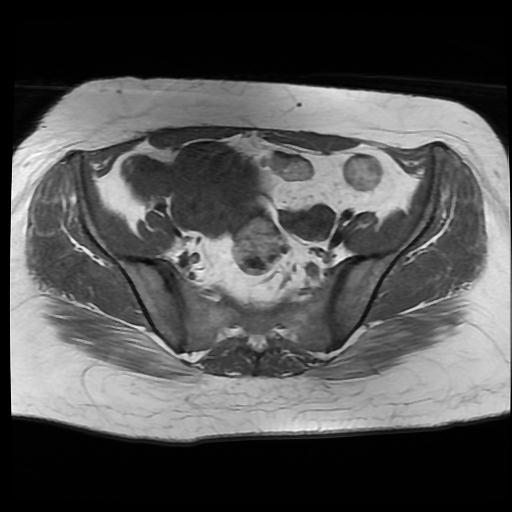 File:Carcinoma of the cervix (Radiopaedia 89018-105858 Axial T1 4).jpg