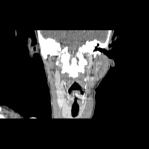 Carcinoma of the maxillary antrum (Radiopaedia 53805-59888 Coronal C+ delayed 102).jpg