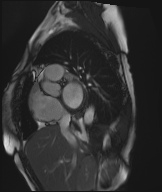 Cardiac amyloidosis (Radiopaedia 51404-57150 Sagittal CINE SSFP 295).jpg