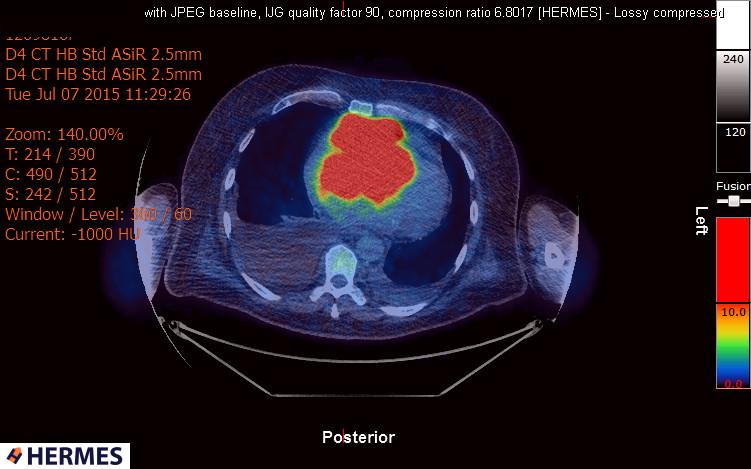 File:Cardiac lymphoma (Radiopaedia 38690-40871 Integrated PET-CT 15).jpg